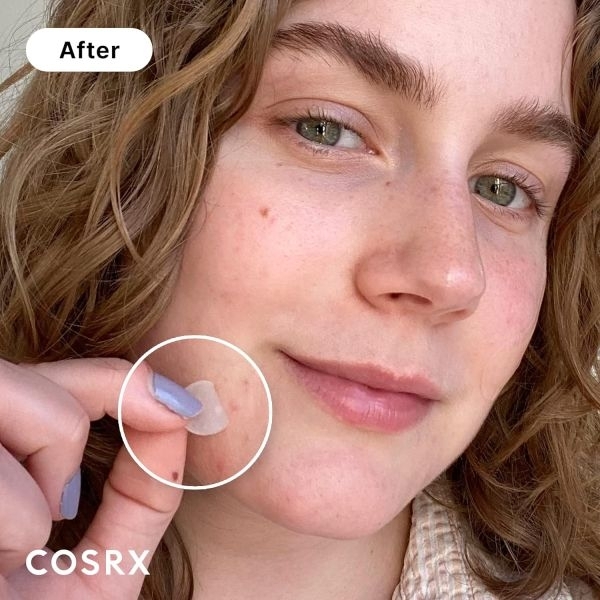 Acne Pimple Patches 24 patches - Image 2
