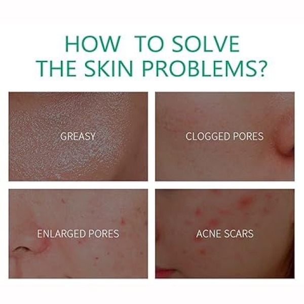 Anti-Acne Cream Treats Pimple Clogged Pores Oil Control Reduces Acne Scars Shrinks Pores 20 G - Image 5
